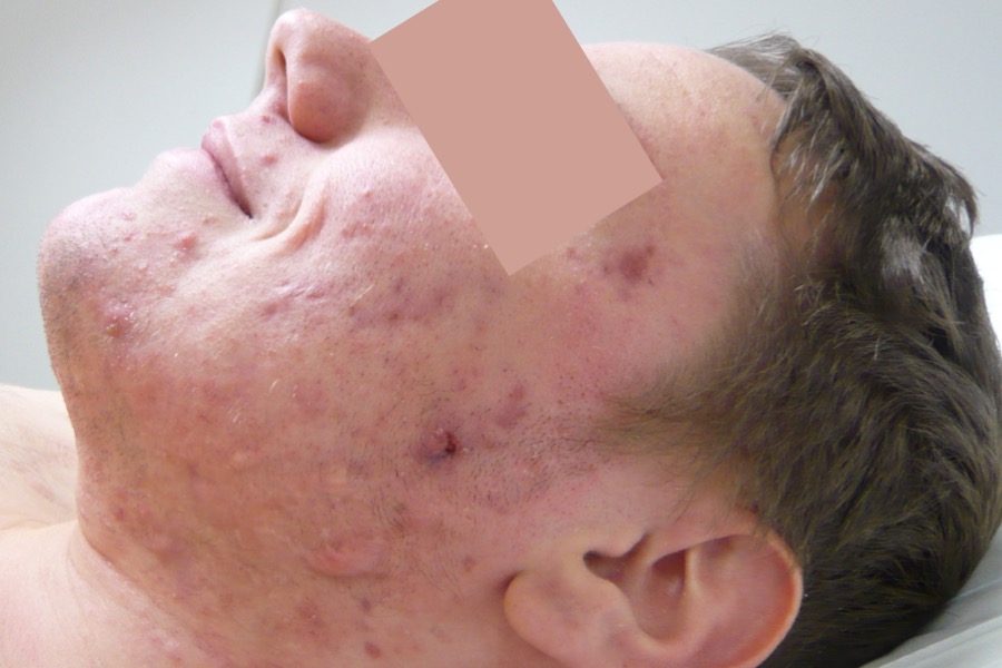 Anke conglobata auf dem Gesicht (nach Behandlung)