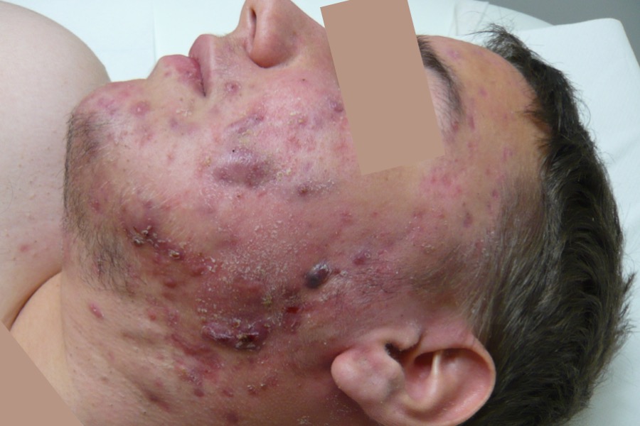 Anke conglobata auf dem Gesicht (vor Behandlung)
