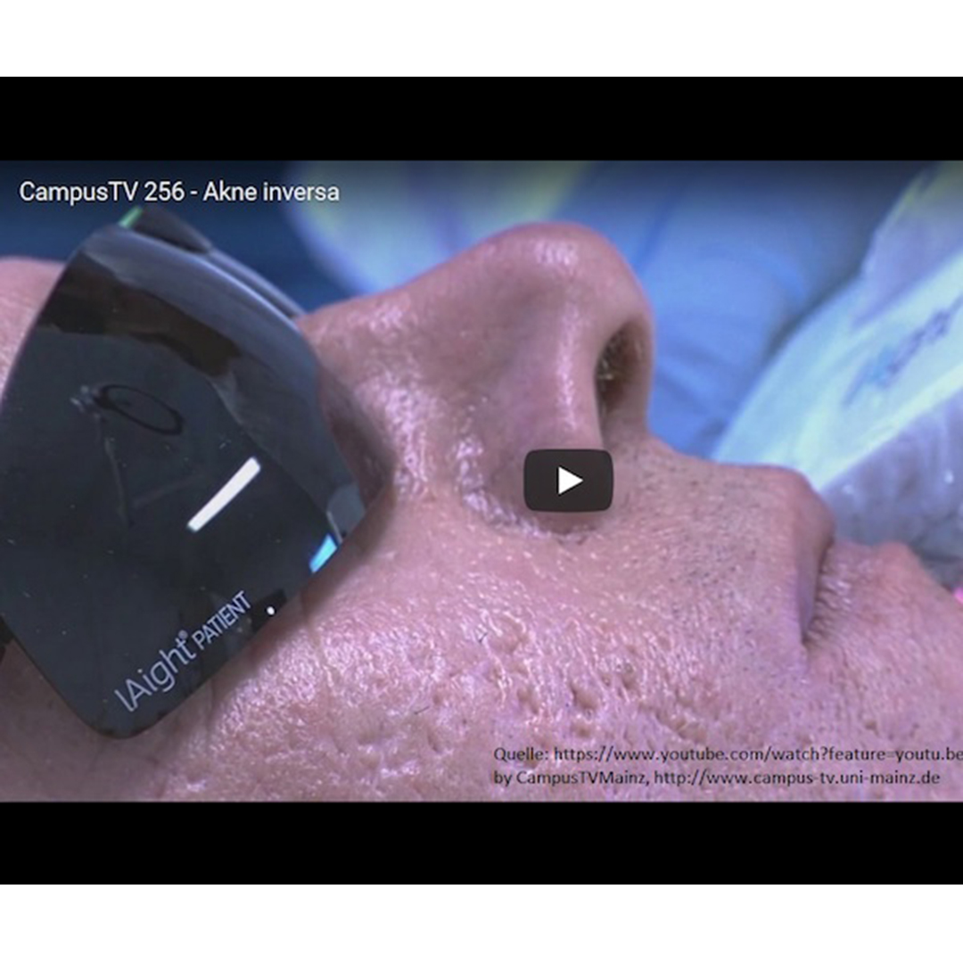 Titelbild des CampusTV Video Beitrages zur LAight-Therapie