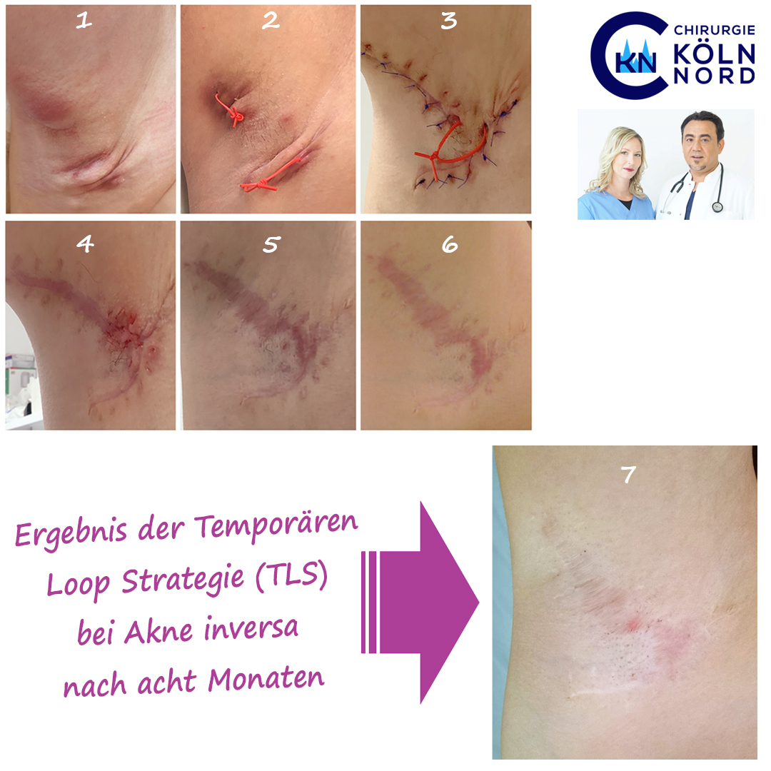 Anhaltender Behandlungserfolg nach der Kombination aus TLS und lAight®-Therapie